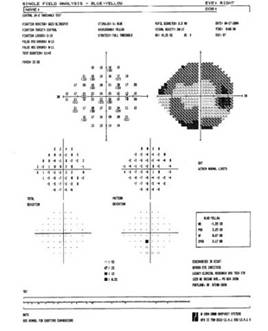 Campo visual de paciente con glaucoma